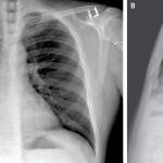 Posteroanterior and Lateral Chest Radiographs, January 19, 2020 (Illness Day 4).No thoracic abnormalities were noted (Snohomish Health District)