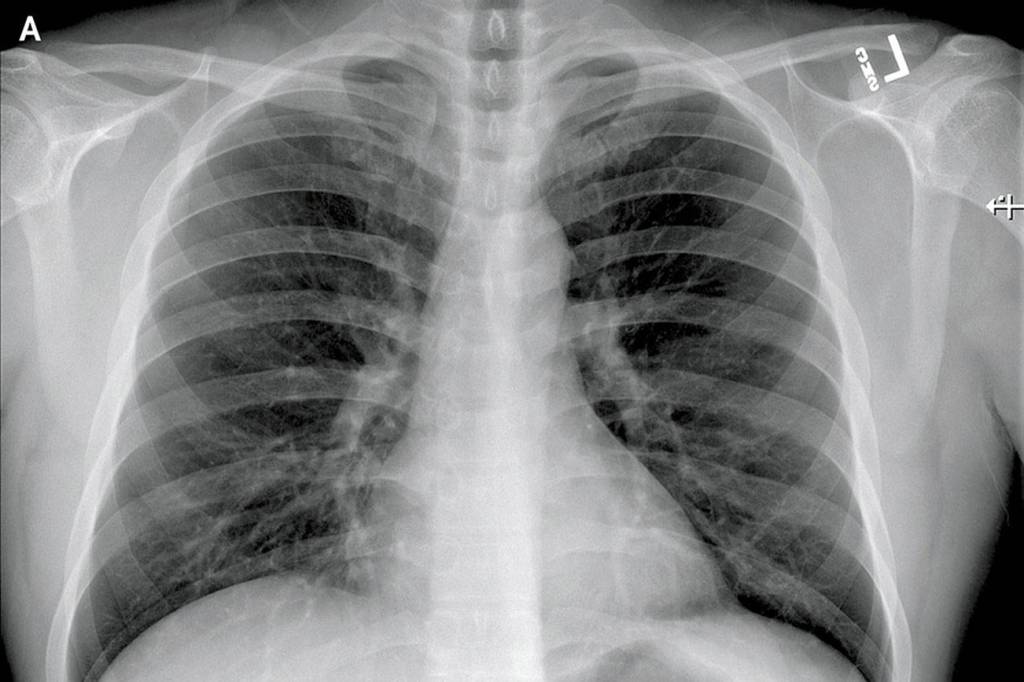 Posteroanterior and Lateral Chest Radiographs, January 19, 2020 (Illness Day 4).No thoracic abnormalities were noted (Snohomish Health District)