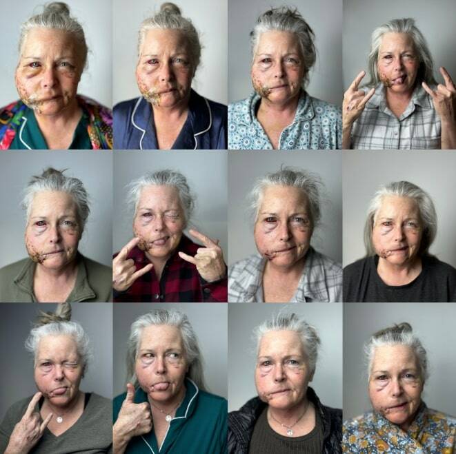 Keri Bergere is still recovering from the February cougar attack. These photos document her progress, according to a post on GoFundMe. Photo courtesy of Kendal McCorkle